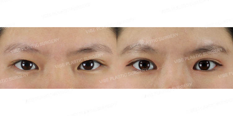 #부분절개 #앞트임