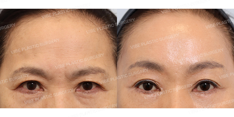 #하안검(재수술) #내시경이마거상