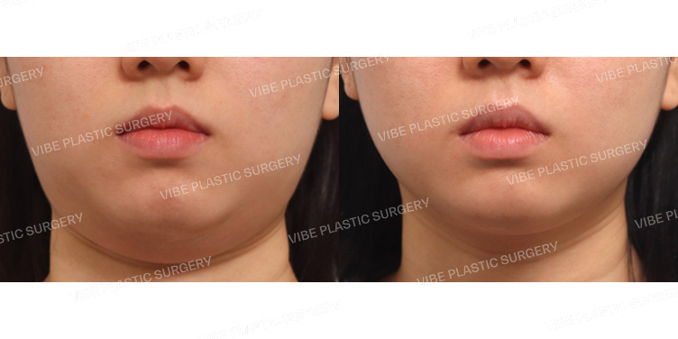 #초음파지방흡입(이중턱,턱라인)