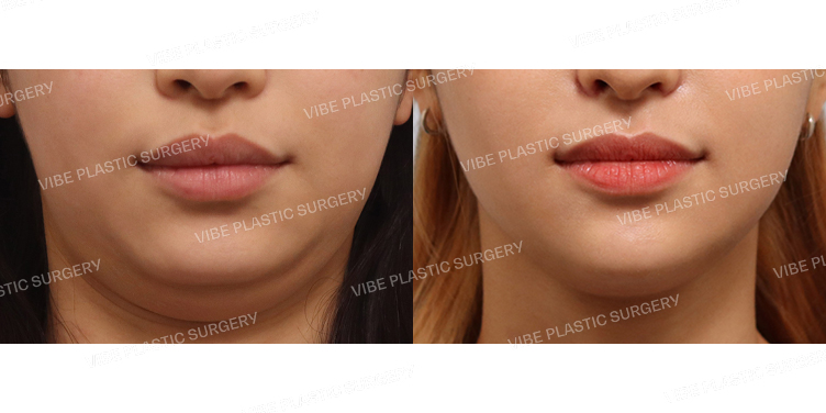 #초음파지방흡입(이중턱,턱라인)