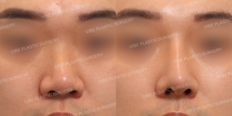 #기능코 #휜코 #매부리코 #복코