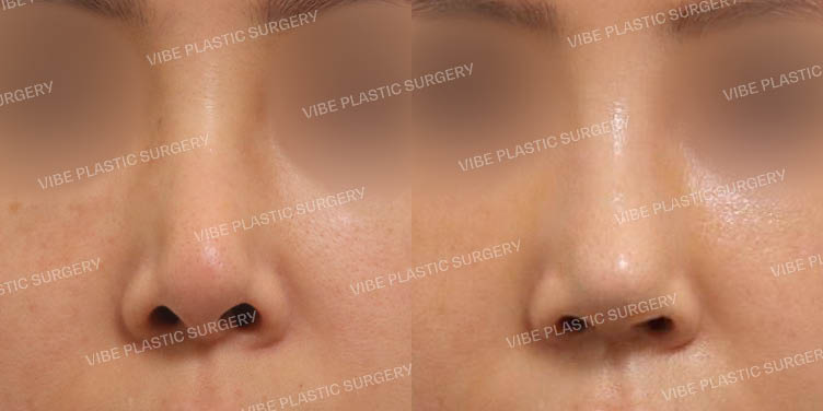 #무보형물 #짧은코 #복코 #비주교정