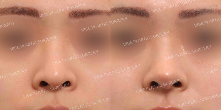 #무보형물 #코끝