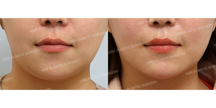 #초음파지방흡입(이중턱,턱라인) #슈링크