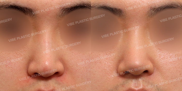 #무보형물 #기능코 #매부리코 #긴코