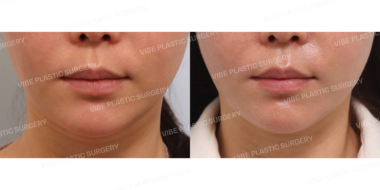 #초음파지방흡입(이중턱,턱라인)