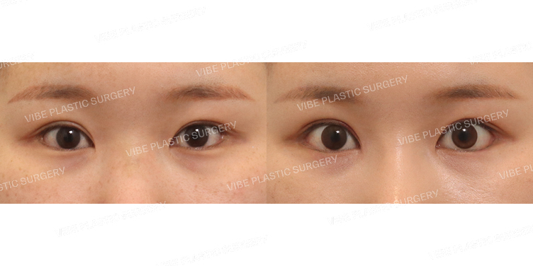 #뒤트임 #밑트임