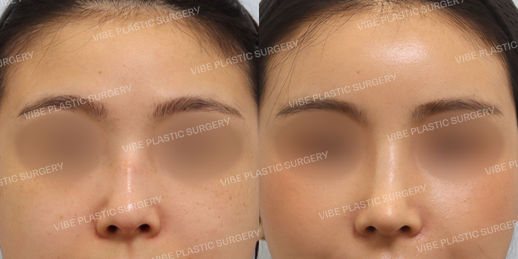 #이마지방이식 #매부리코 #무보형물