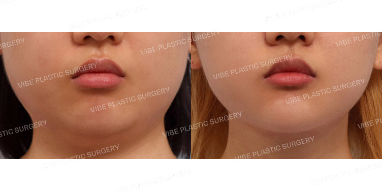 #초음파지방흡입(이중턱,턱라인)