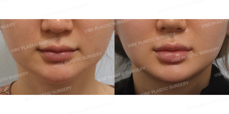 #초음파지방흡입(이중턱,턱라인)