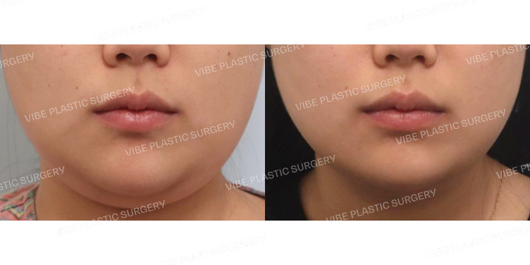 #초음파지방흡입(이중턱,턱라인)