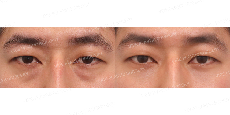 #눈밑지방재배치 #PRP주사