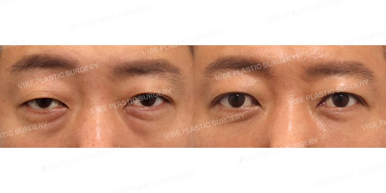 #절개눈매교정 #눈밑지방재배치