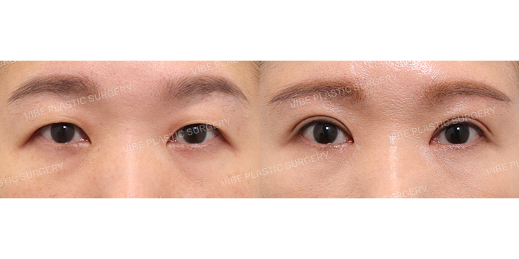 #중년눈성형 #눈썹밑거상 #비절개눈매교정 #앞트임