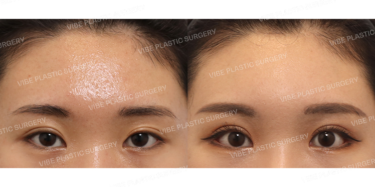 #비절개눈매교정 #뒤트임 #밑트임 #내시경이마거상