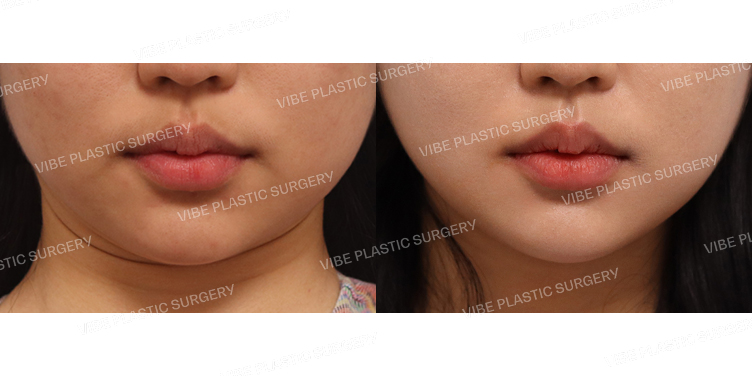 #초음파지방흡입(이중턱,턱라인)