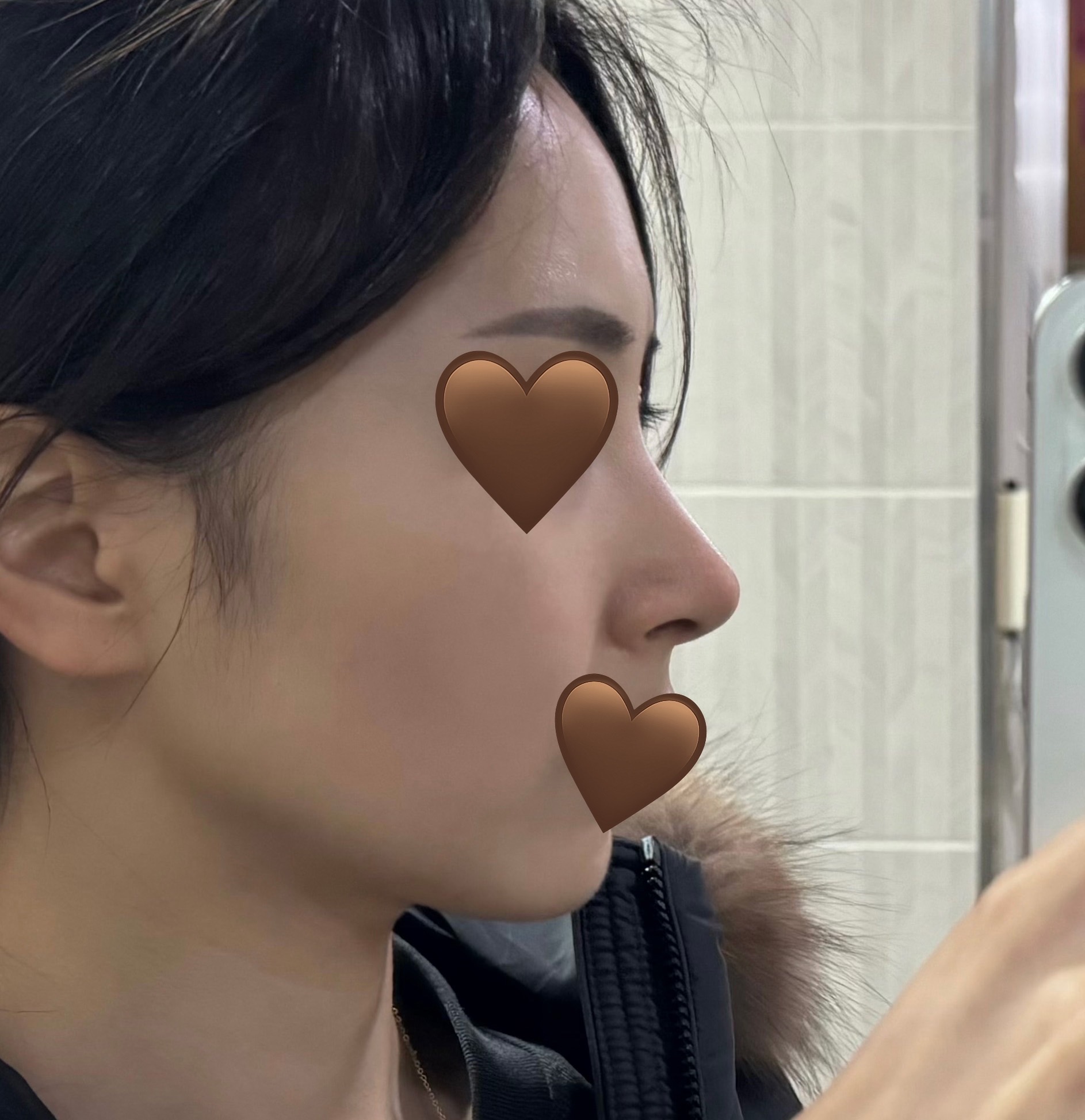 바이브성형외과 코성형 추천해요>.<