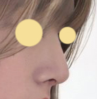 무보형물 코성형 3개월차 지나가용