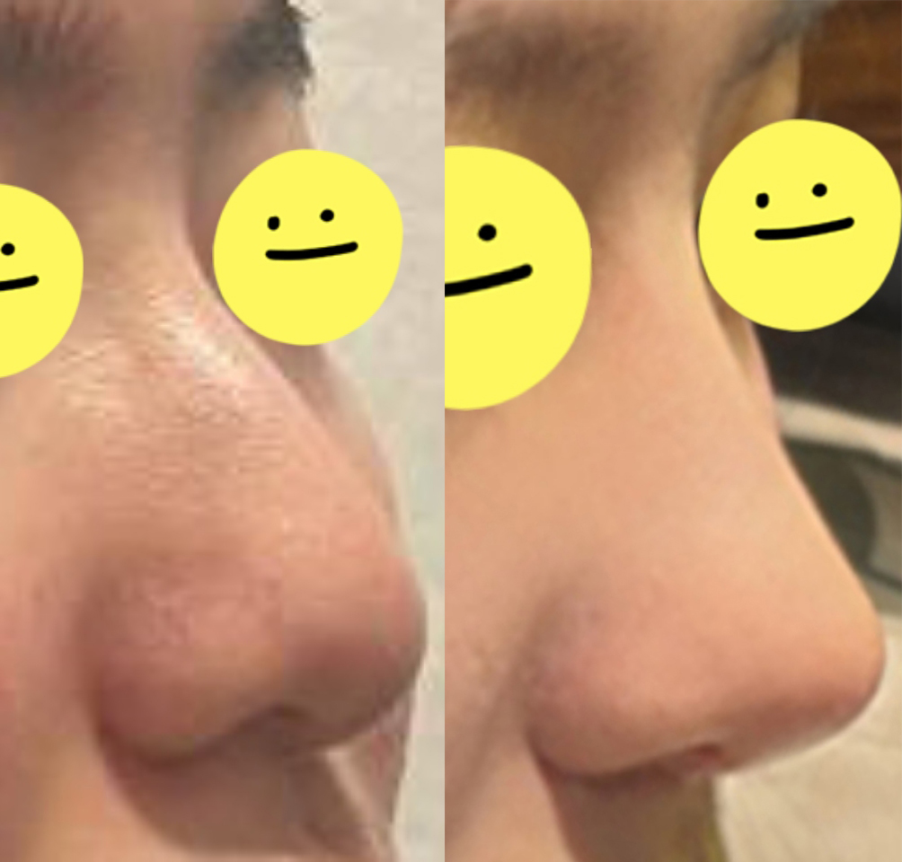 코 컴플렉스 해결 ㅎㅎ