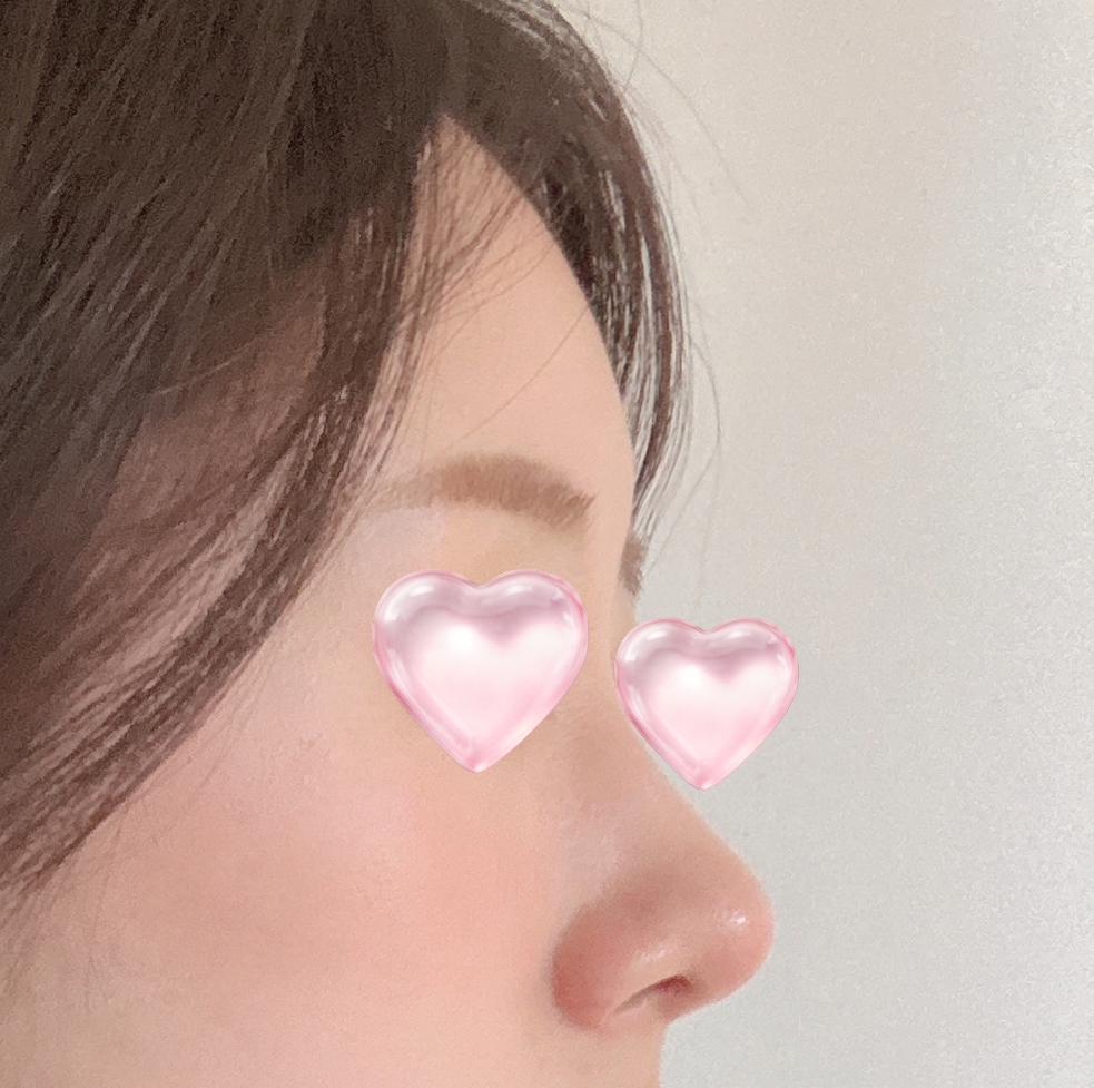 코, 지방이식 3개월차 후기올려보아요~