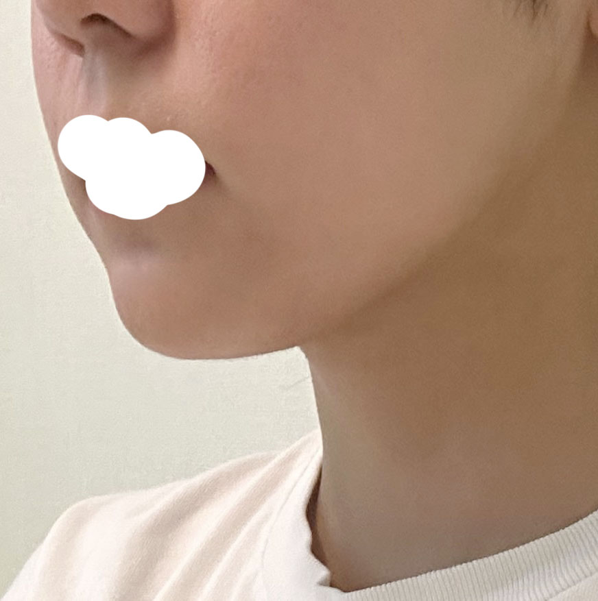 이중턱지방흡입 후기요!