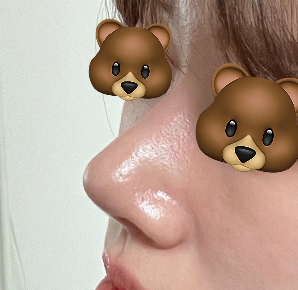 보형물없이 코수술 5갤차!