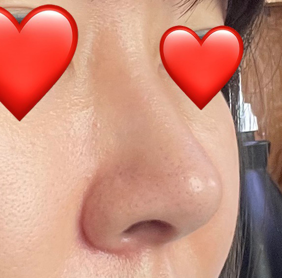 무보형물코수술 매우 만족합니다