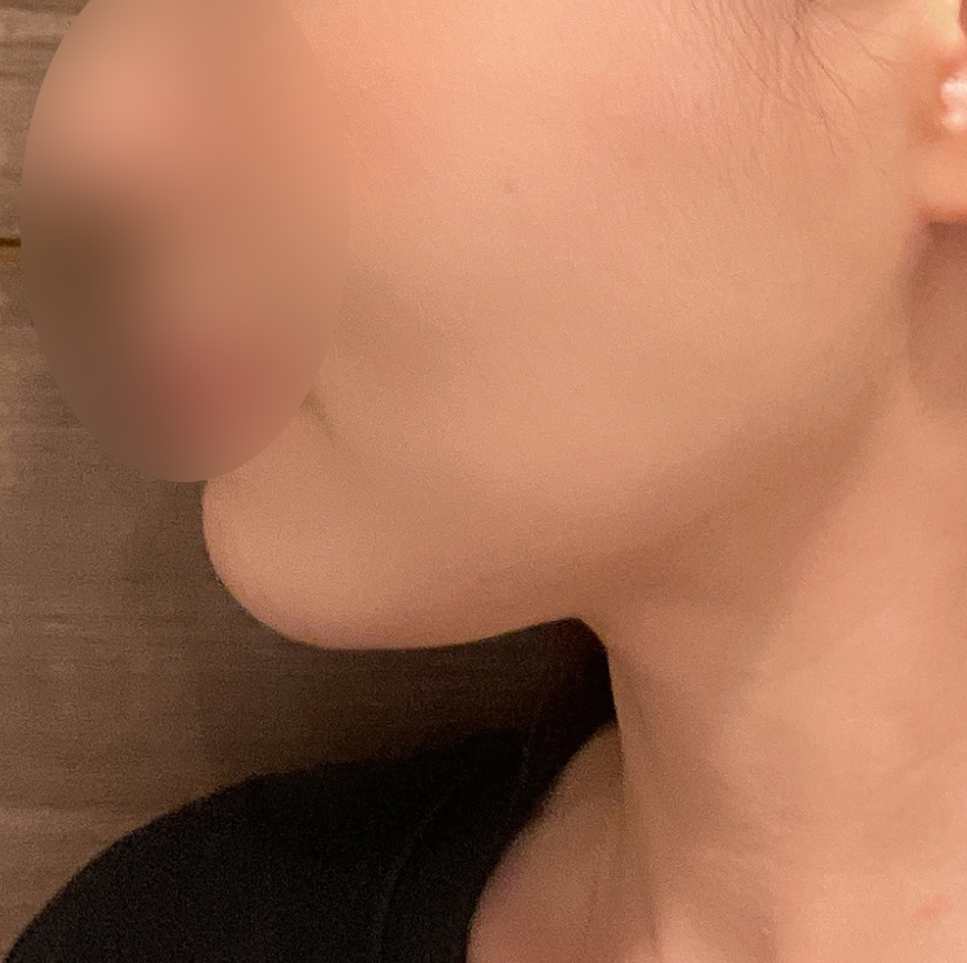 얼굴지방흡입하고 글씁니다~