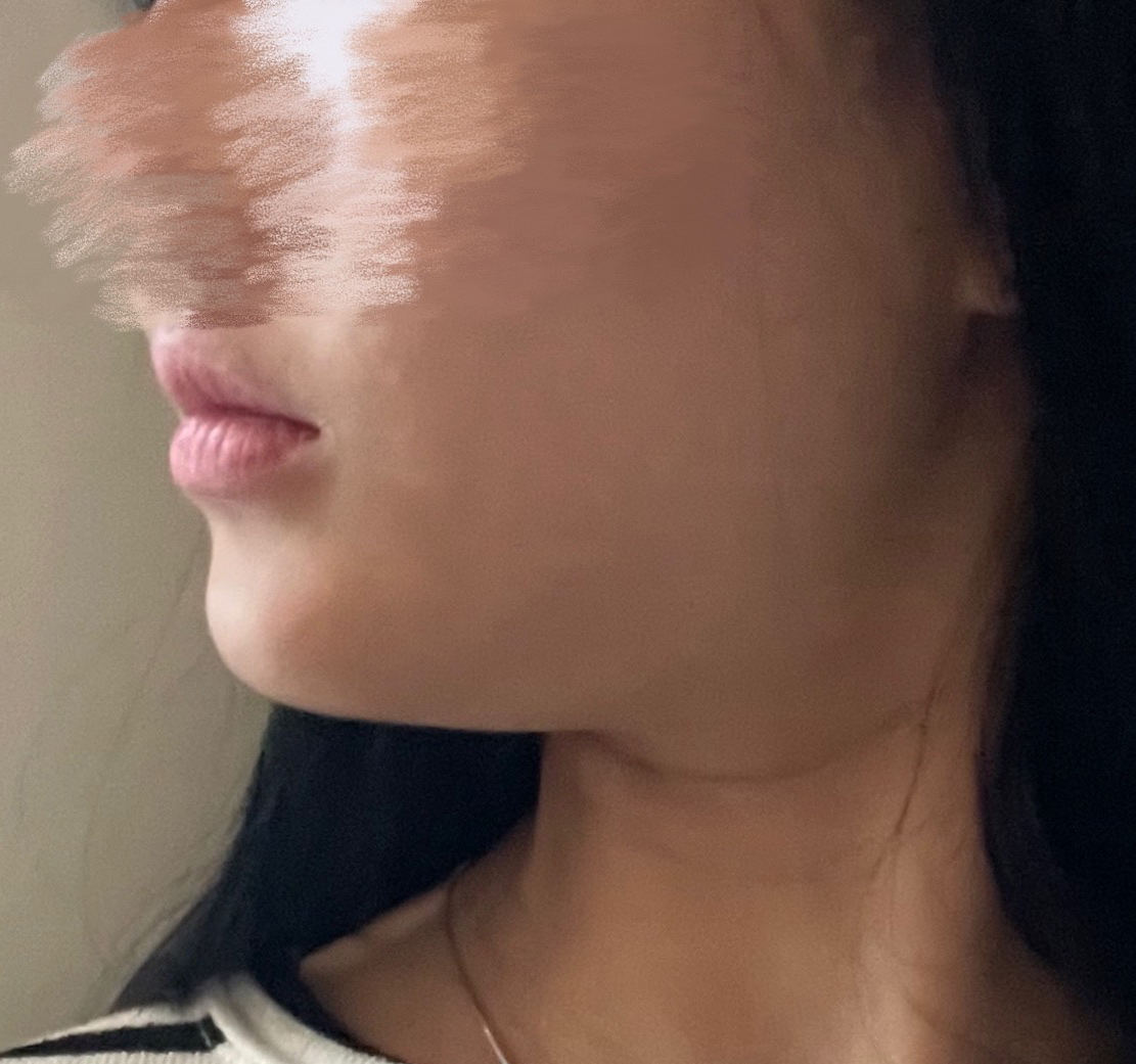 턱살고민이라면 바이브 얼지흡 ㅊㅊ