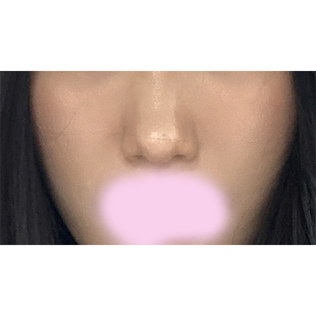 볼, 팔자 지방흡입 후기