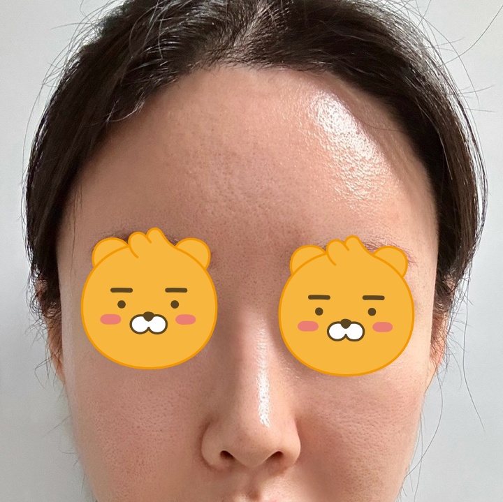 지방이식, 코재수술 3개월정도 됐습니당