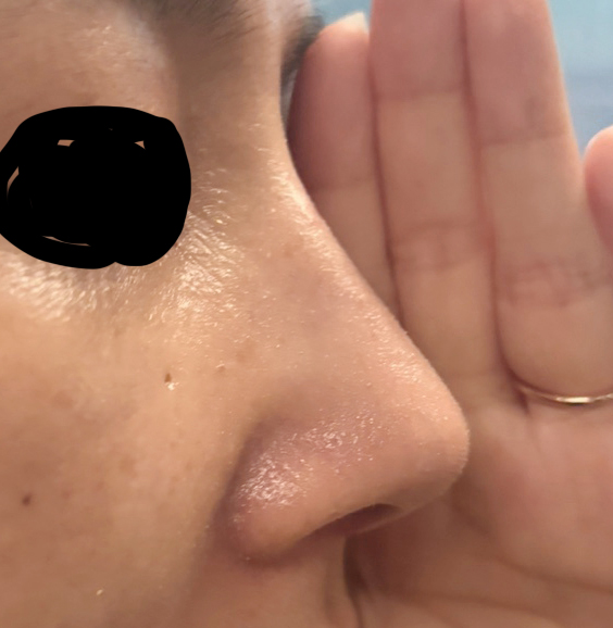 발품 열심히 팔고 바이브에서 코수술!