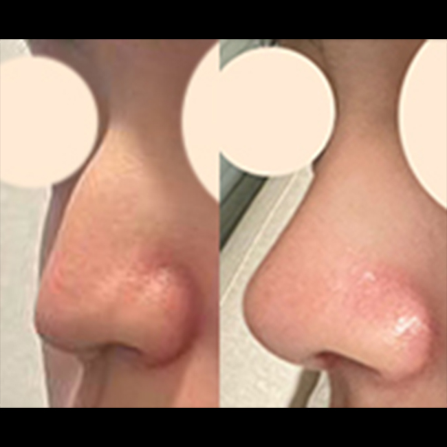 무보형물 매부리코성형 3주차!