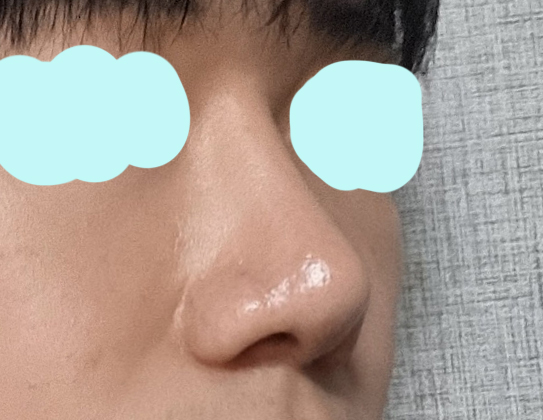 남자코성형 강추입니다.