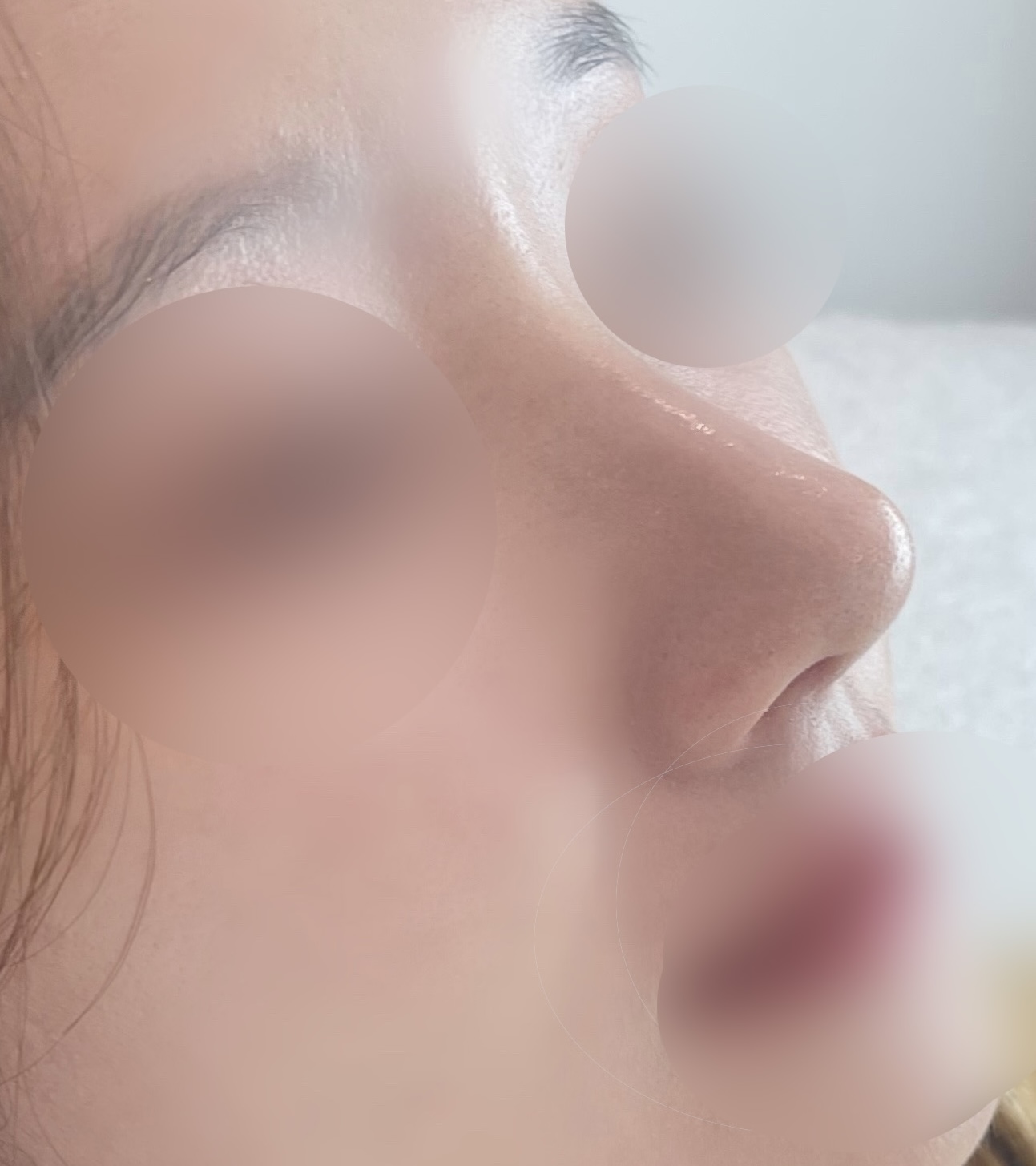 무보형물 코수술 한달차후기