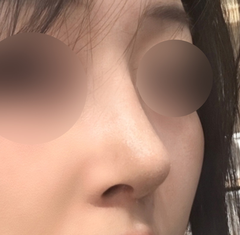 코수술받고 3주차됐어용