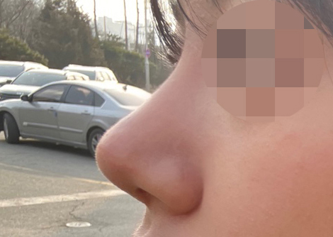 코수술 3주차됐어욥 ㅎㅎ