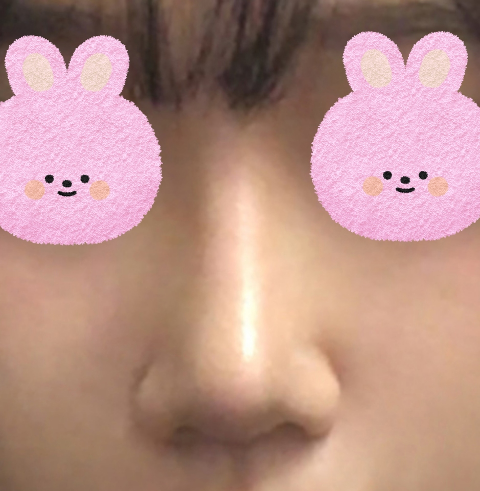 바이브에서 코성형 성공성공~