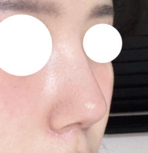 코수술 후회1도 없고 만족만족!