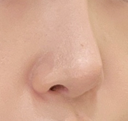 비공내리기 재수술 세달된 만족후기~