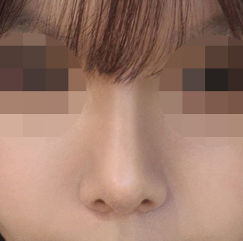 유영문원장님께 수술받길 잘했어요 ㅠㅠ!