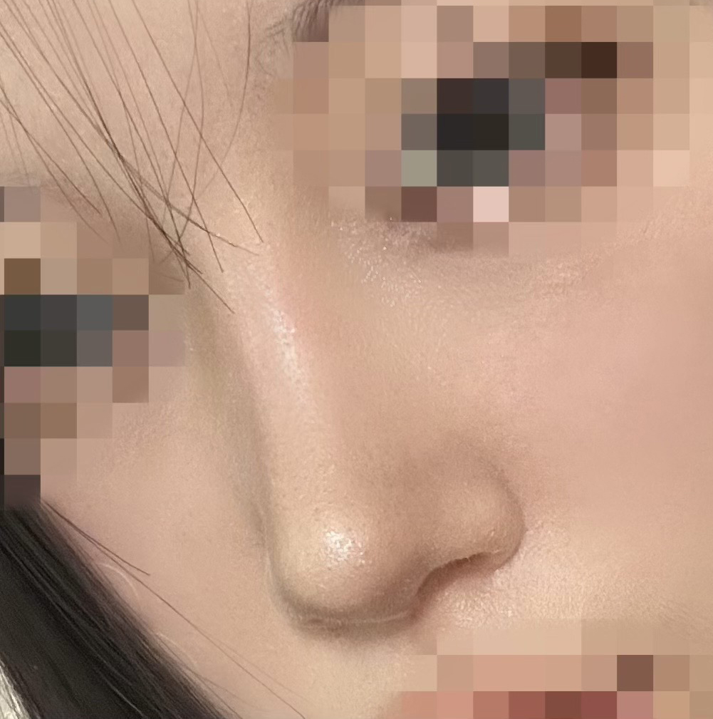 낮은코가 오똑해졌슴당