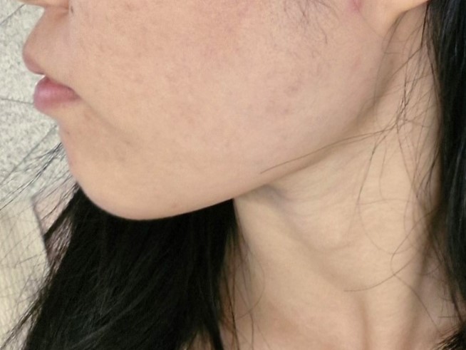 지방흡입 수술 후 호빵맨이였던 별명 사라졌어요 ~!