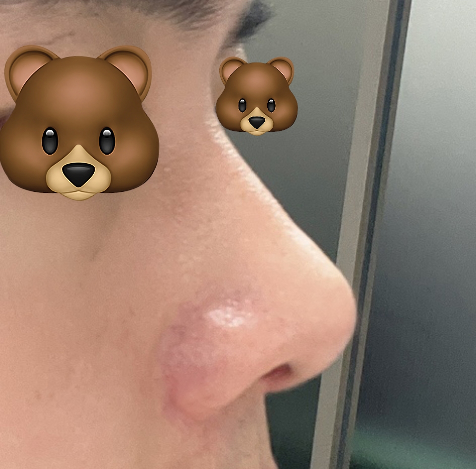 남자코성형 대만족중입니다:)