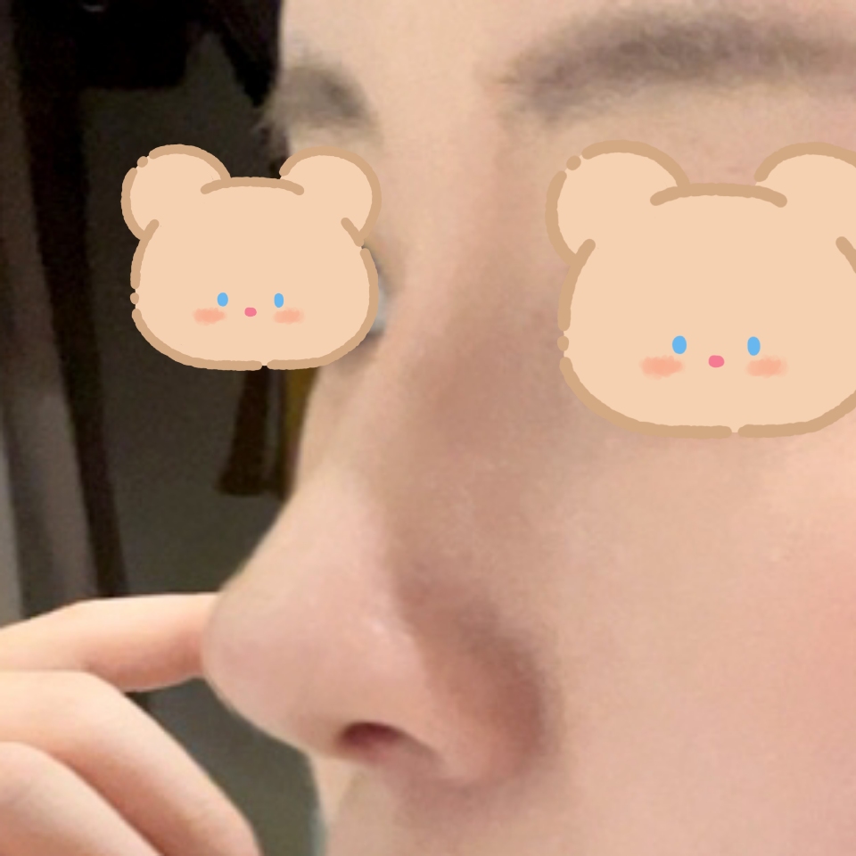 이젠 정말 제 코 같고 자연스러워요