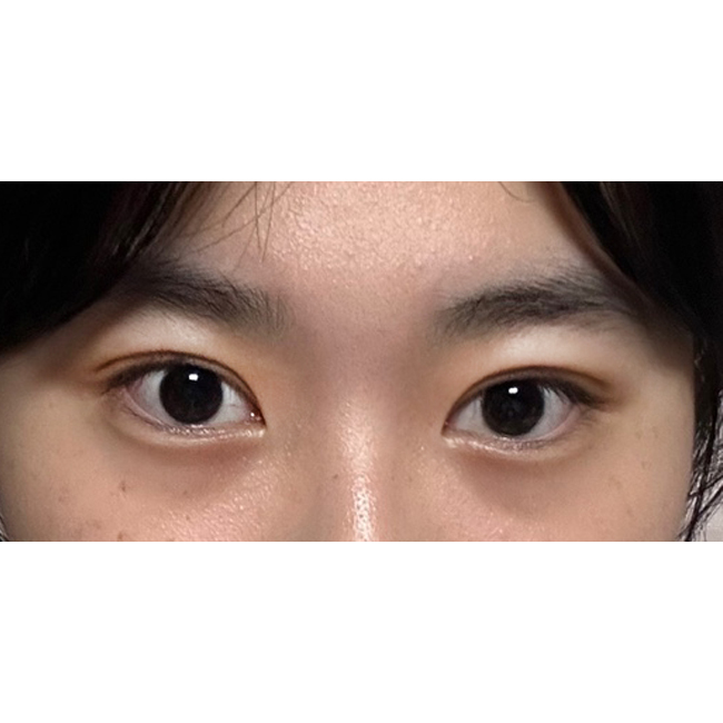 부분절개 눈매교정 3개월 후기 넘 예뻐용><