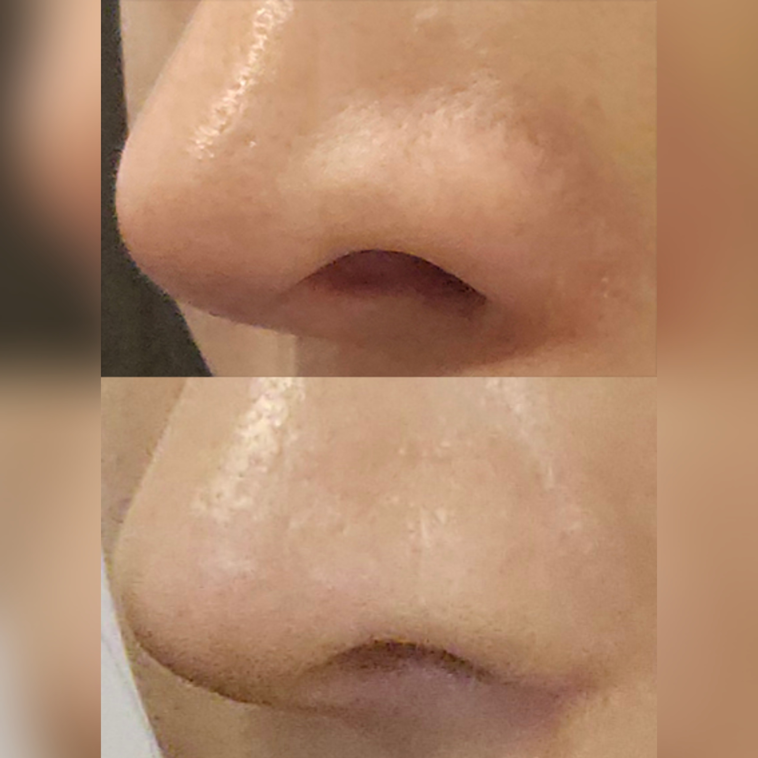 비공내리기 6개월차