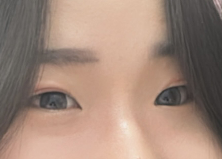 수술전__3__-_눈.jpg