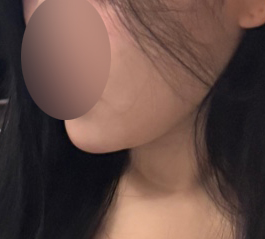 바이브에서 이중턱 없앤 후기!