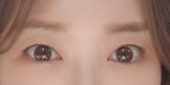 눈밑지방재배치 만족도 최상입니다 ~!